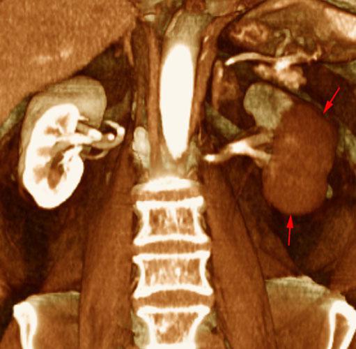 Infarto renal segmentario