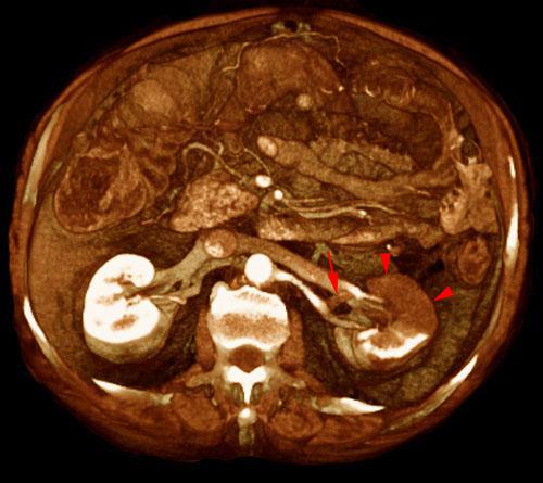 Infarto renal segmentario