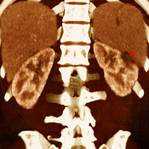 Infartos renales múltiples