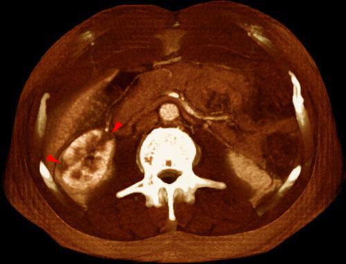 Infartos renales múltiples