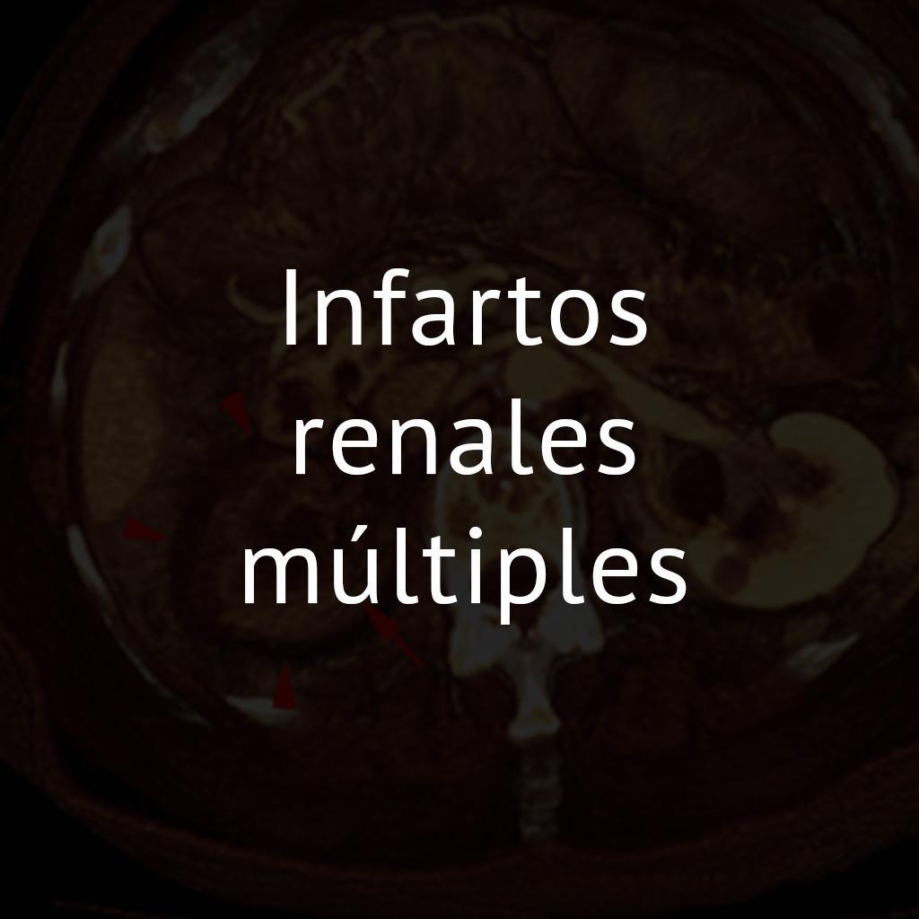 Infartos renales múltiples