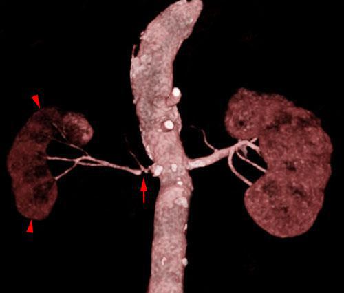 Isquemia renal crónica
