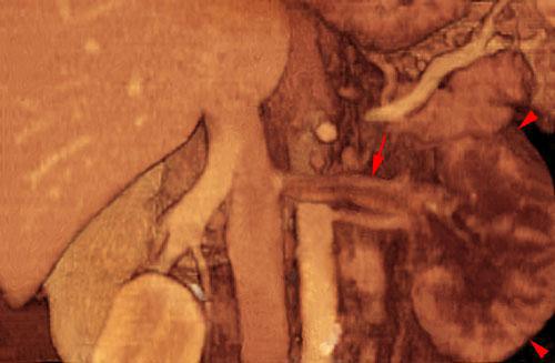 Trombosis venosa renal