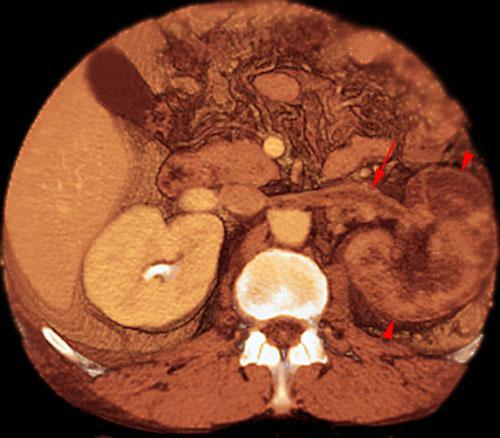 Trombosis venosa renal