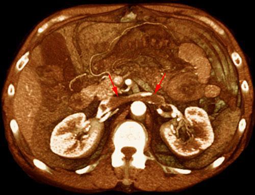 Trombosis de la vena renal izquierda