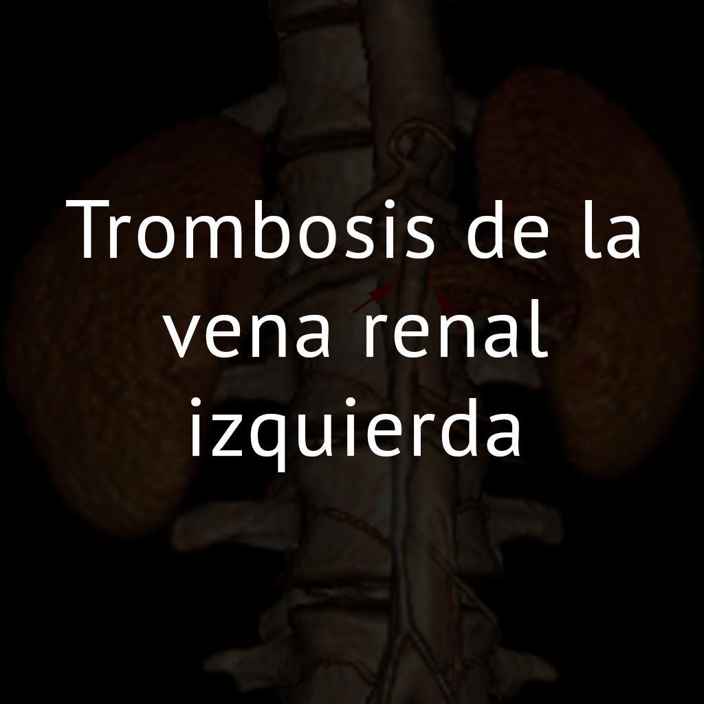 Trombosis de la vena renal izquierda