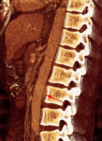 Síndrome del cascanueces retroaórtico