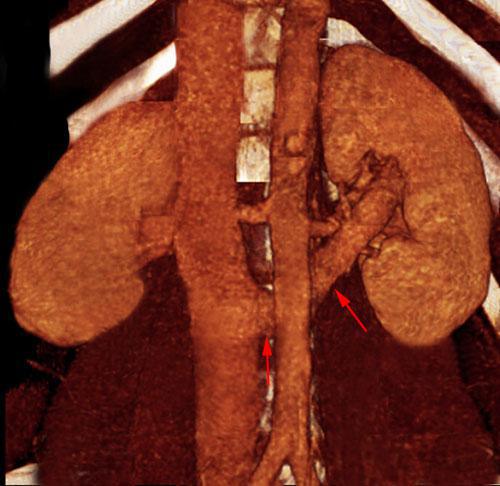 Síndrome del cascanueces retroaórtico