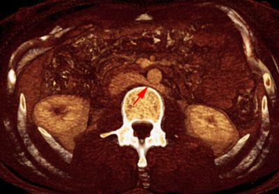 Síndrome del cascanueces retroaórtico