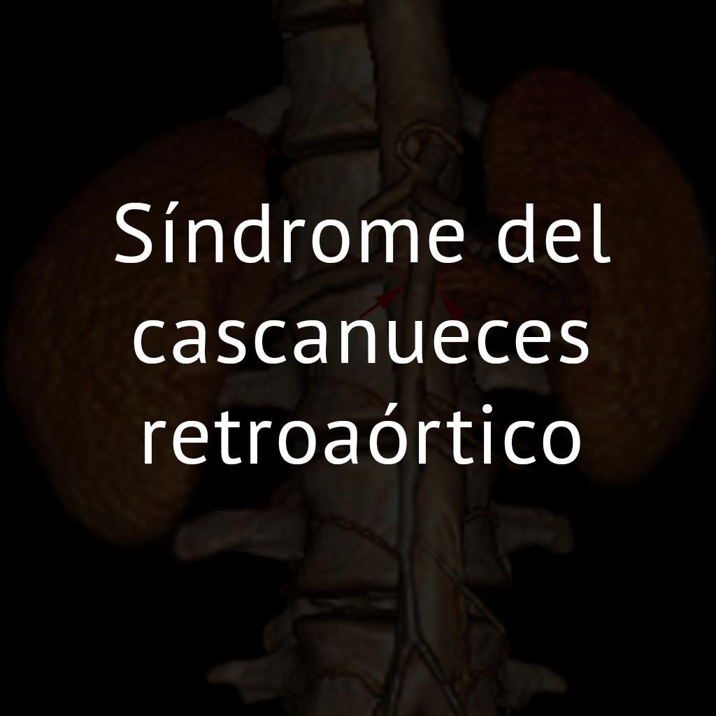 Síndrome del cascanueces retroaórtico