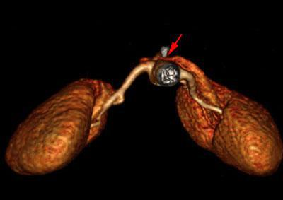 Síndrome del cascanueces