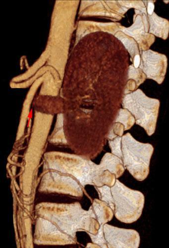 Síndrome del cascanueces 