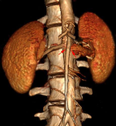 Síndrome del cascanueces 