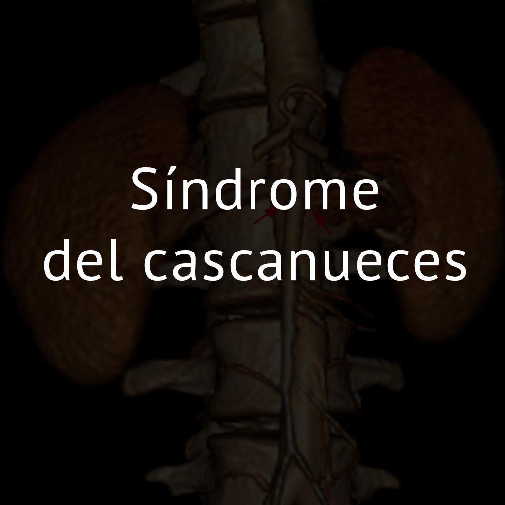 Síndrome del cascanueces 