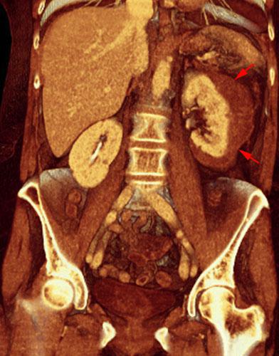 Hematoma subcapsular