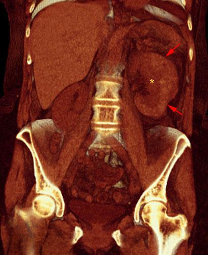 Hematoma subcapsular