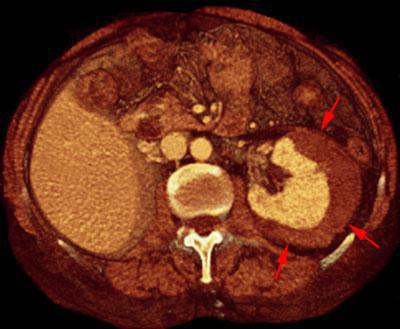 Hematoma subcapsular