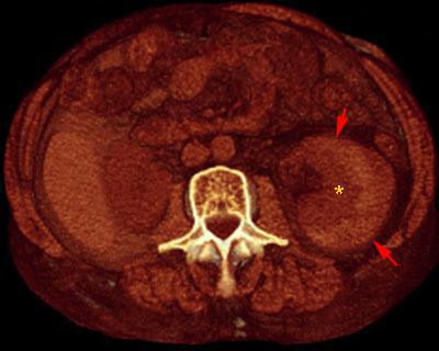 Hematoma subcapsular