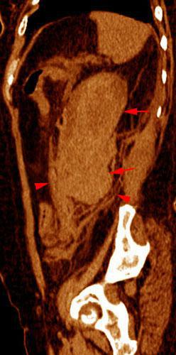 Hematoma subcapsular y perirrenal