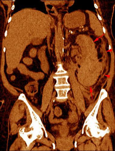 Hematoma subcapsular y perirrenal