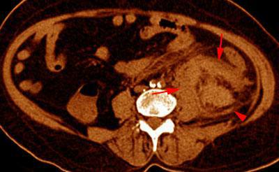 Hematoma subcapsular y perirrenal