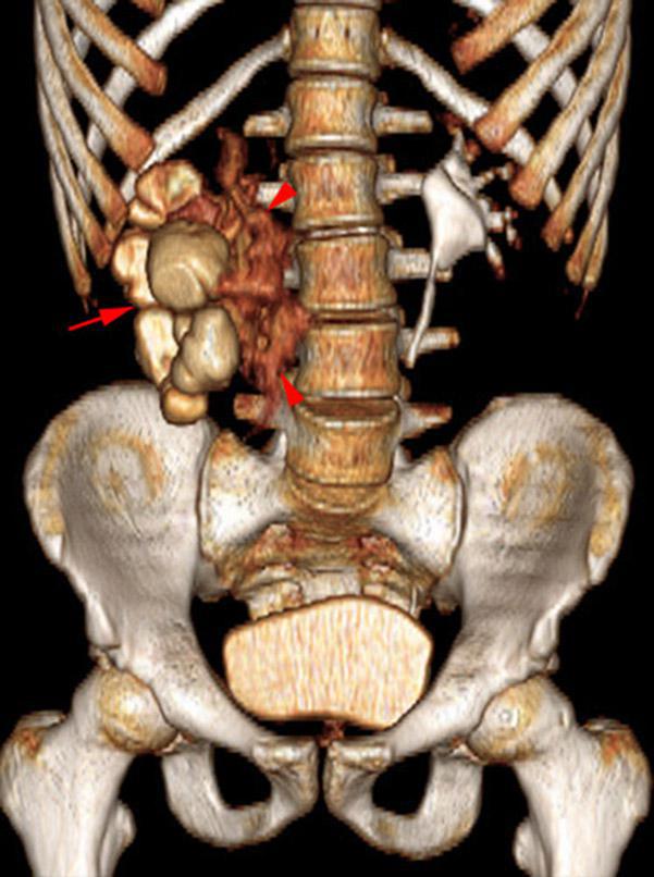 Rotura pielocalicial