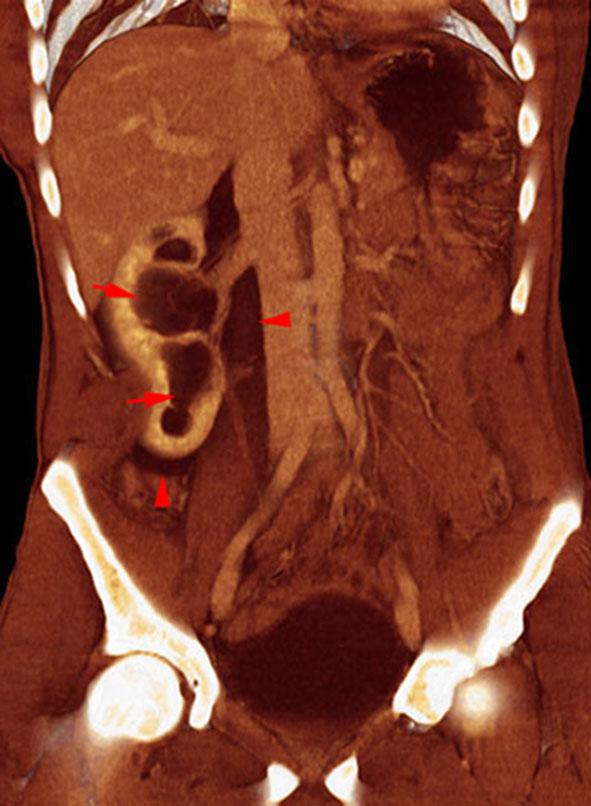 Rotura pielocalicial