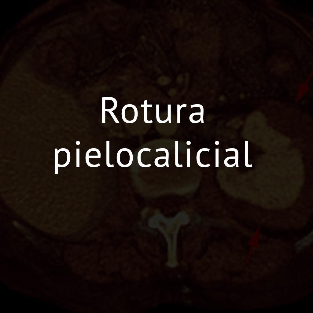 Rotura pielocalicial