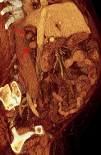 Recidiva adenopática de hipernefroma