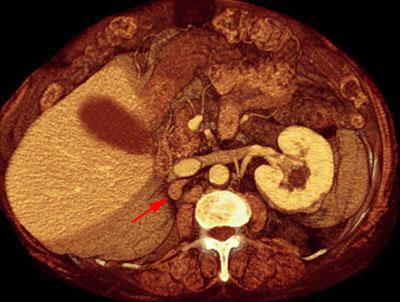 Recidiva adenopática de hipernefroma