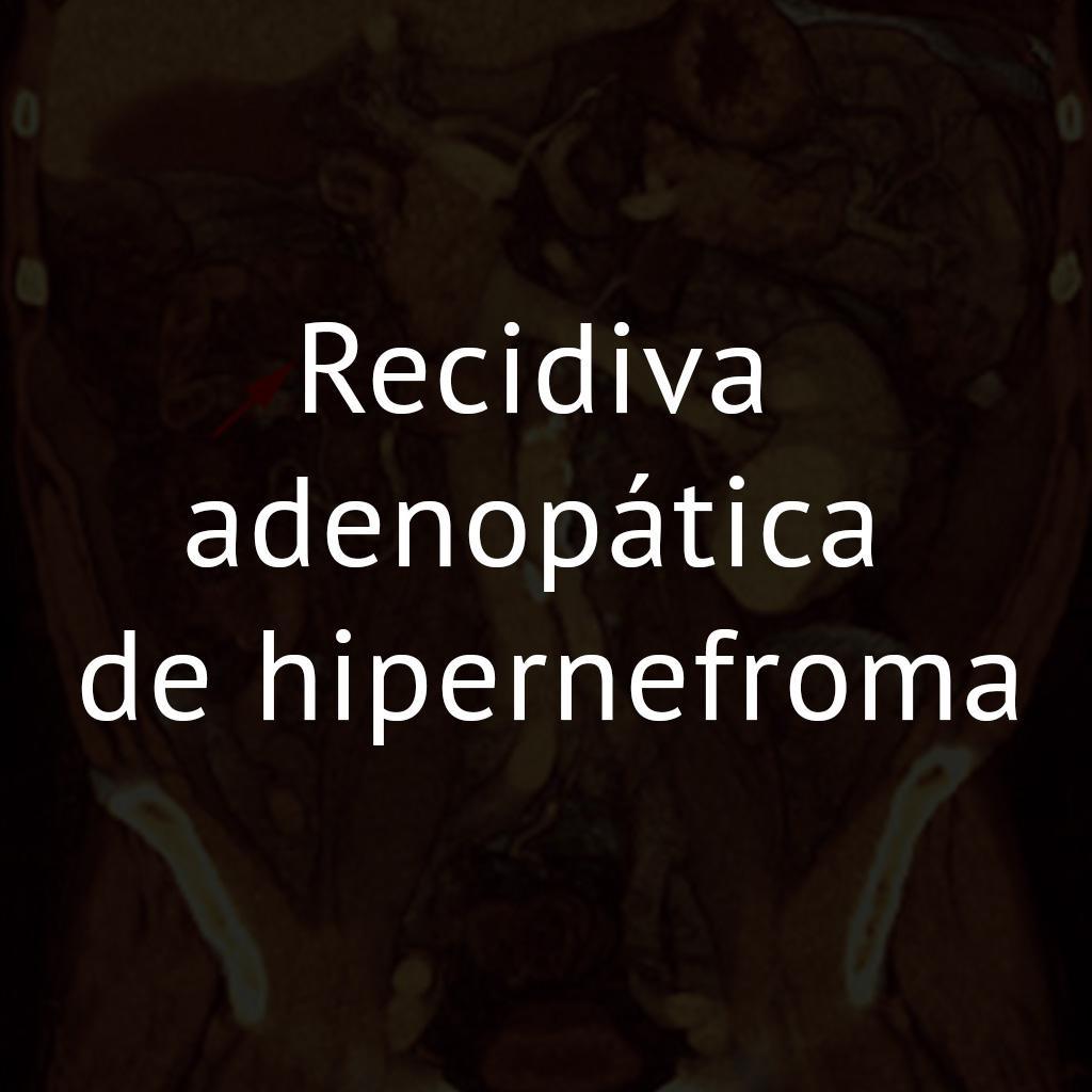 Recidiva adenopática de hipernefroma