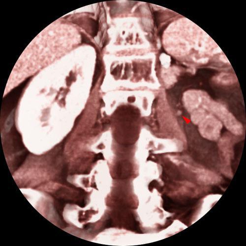 Recidiva local de hipernefroma