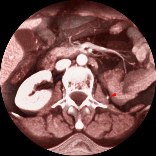 Recidiva local de hipernefroma