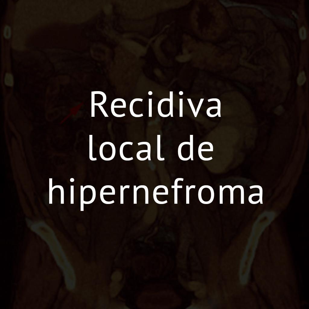 Recidiva local de hipernefroma