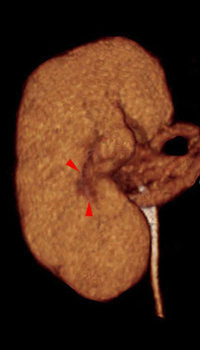 Nefrectomía parcial. Tumorectomia