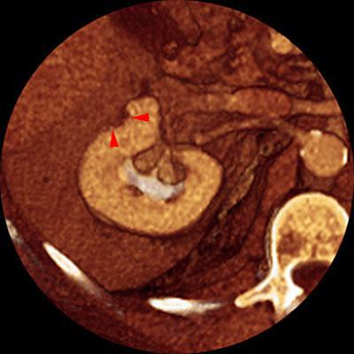Nefrectomía parcial. Tumorectomia