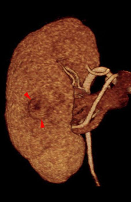 Nefrectomía parcial. Tumorectomia
