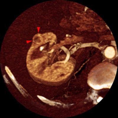 Nefrectomía parcial. Tumorectomia