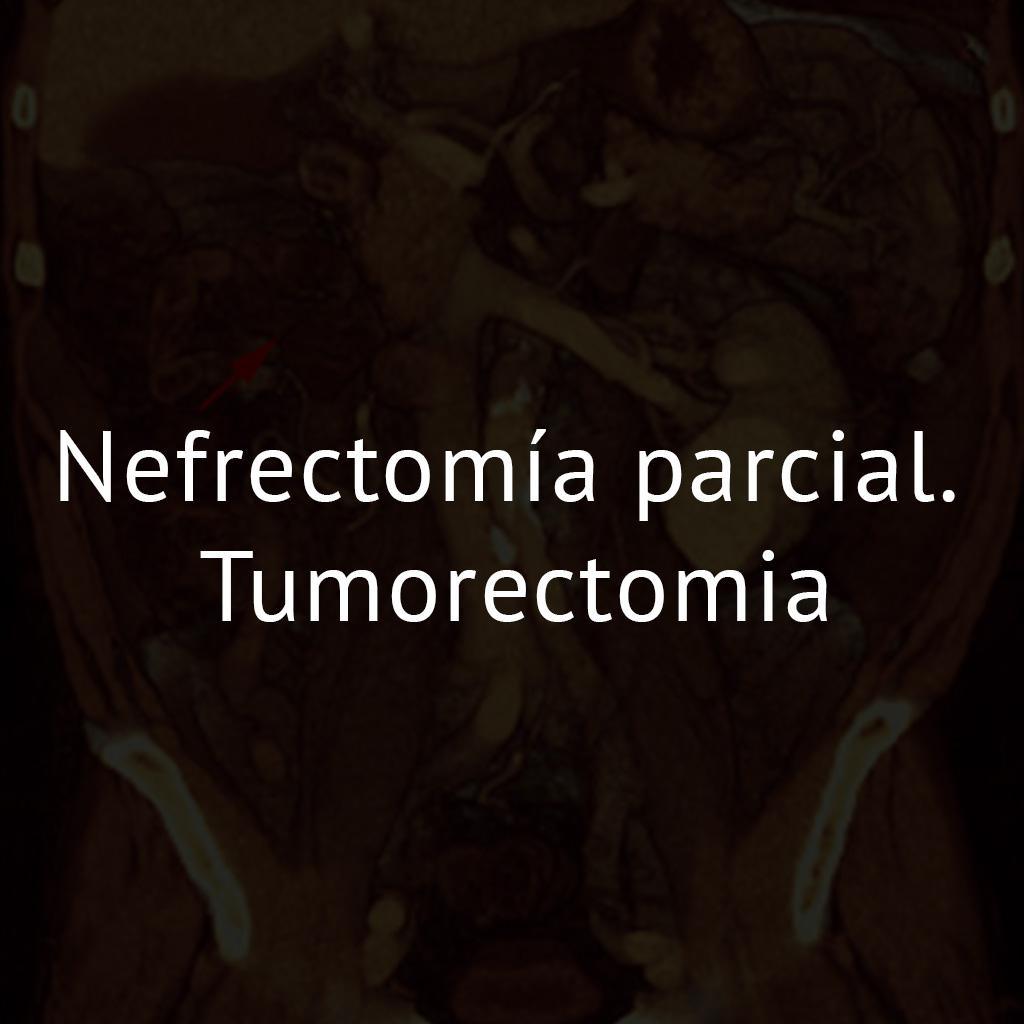 Nefrectomía parcial. Tumorectomia