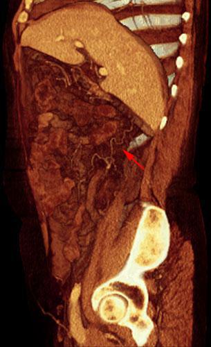 Nefrectomía radical