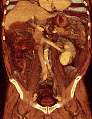 Nefrectomía radical