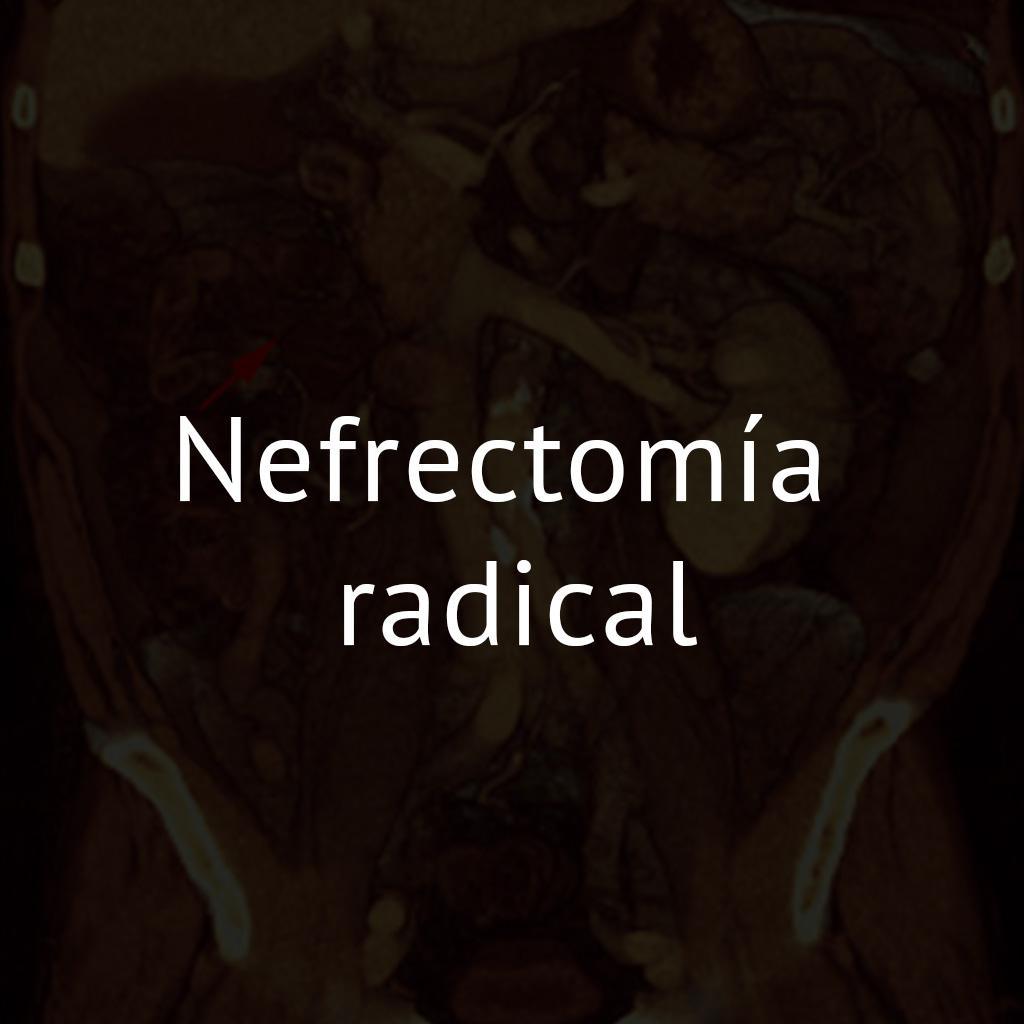 Nefrectomía radical