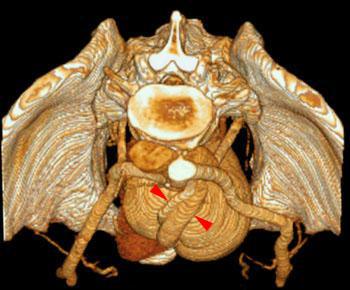 Riñón único pélvico