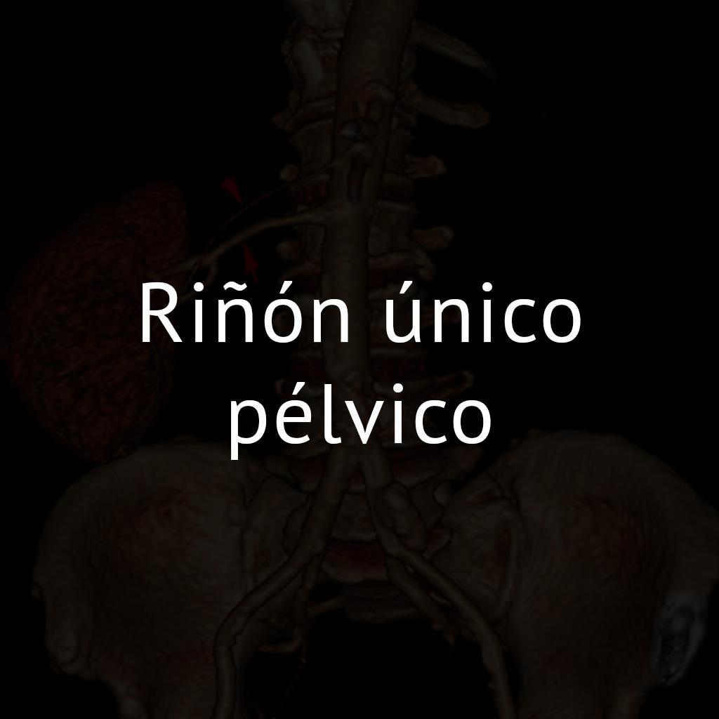 Riñón único pélvico