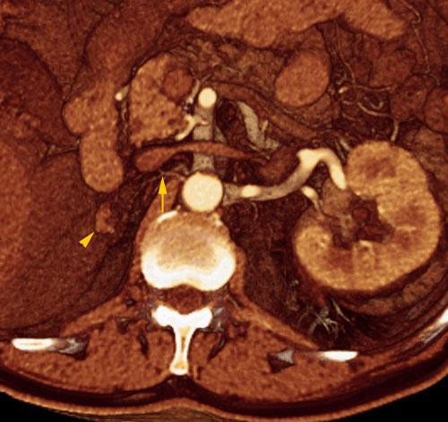 Hipoplasia renal 1