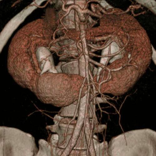 Malrotación renal en riñón en herradura