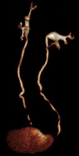 Riñón horizontalizado