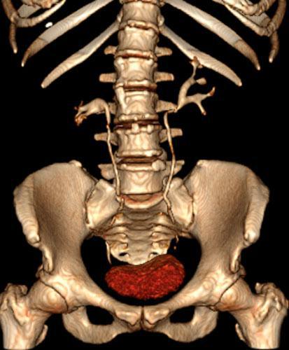 Riñón horizontalizado
