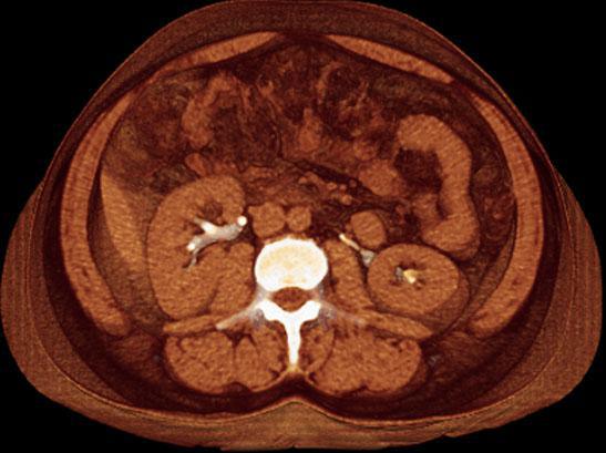 Riñón horizontalizado