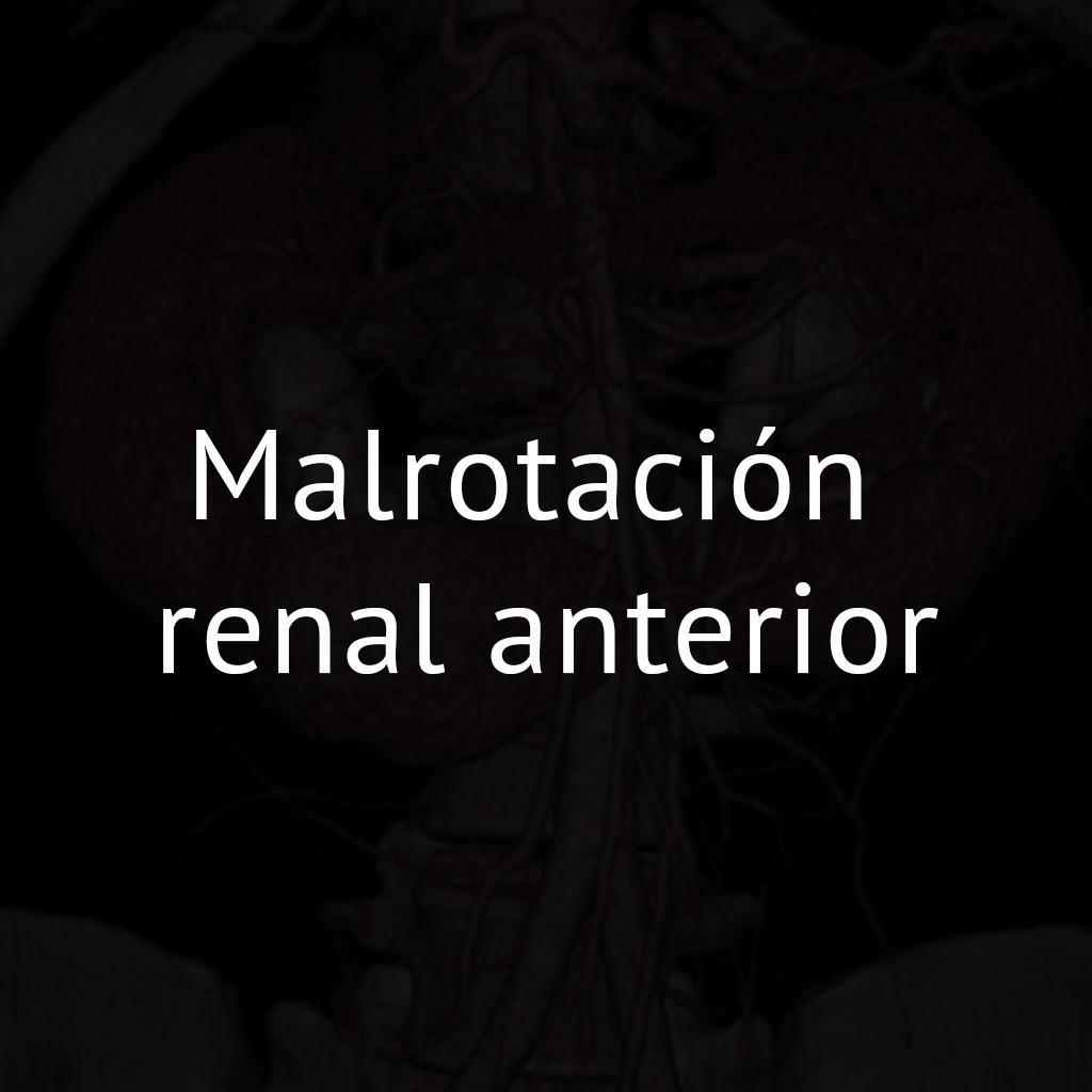 Malrotación renal anterior